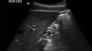 Ultrasound Assessment of Gastric Content course image