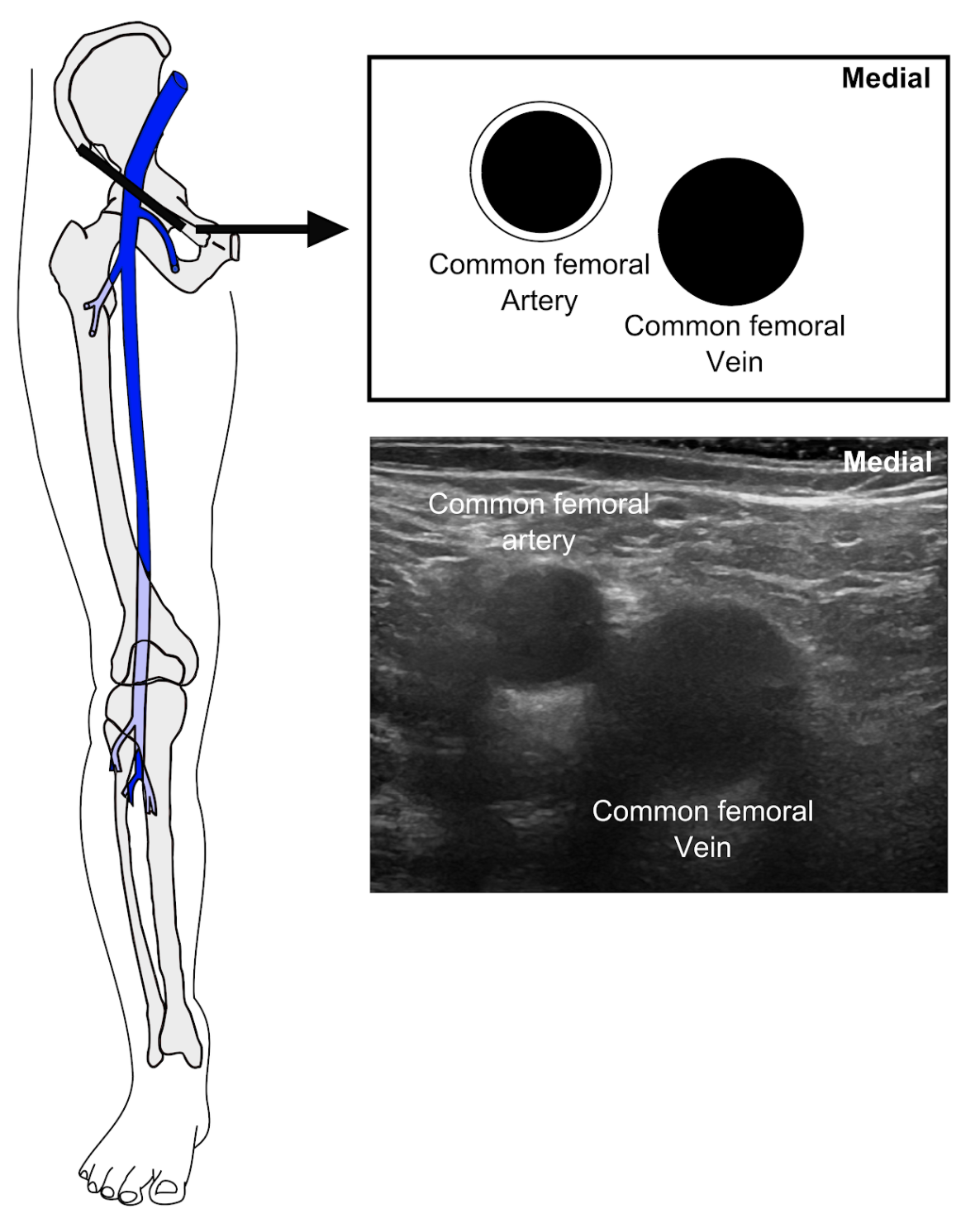 proximal superficial femoral vein
