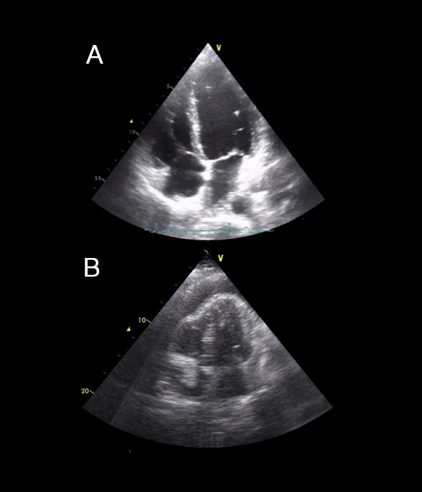 22 Pericardial fluid collection examples USabcd