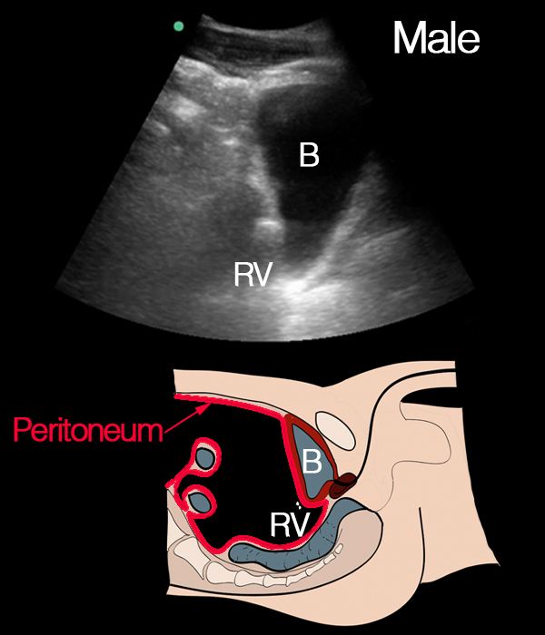 rectouterine pouch ultrasound
